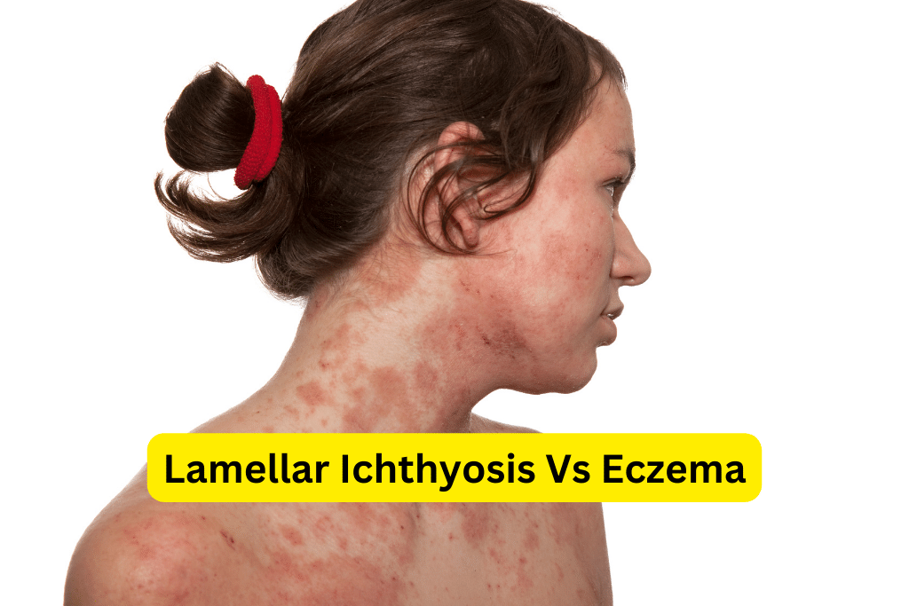 Ichthyosis Vs Eczema Insights Treatment Options Lamellar