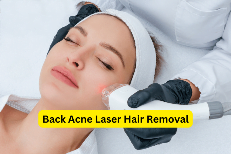 Goodbye to Back Acne: Benefits of Laser Hair Removal for Clear Skin 