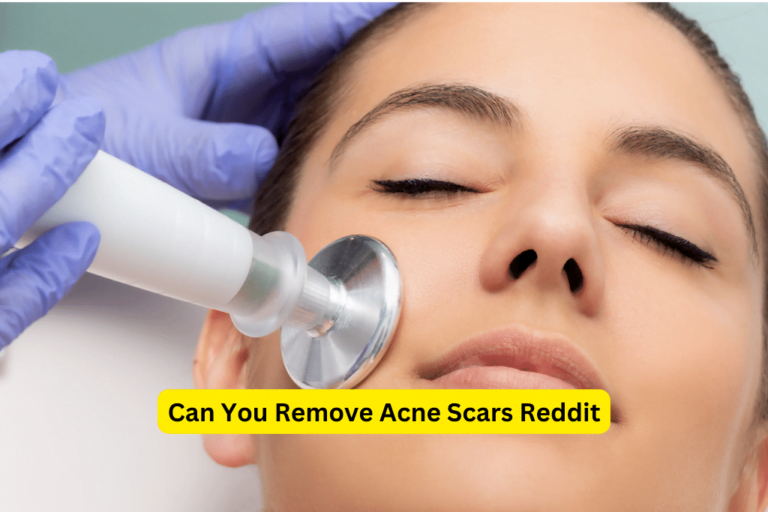 Reddit’s Top Solutions for Acne Scars: Achieve Clear Skin