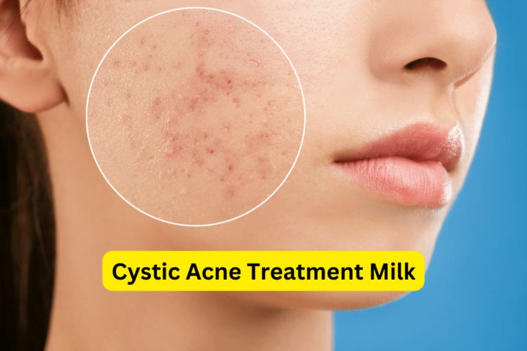 Milk: Natural Remedy for Cystic Acne
