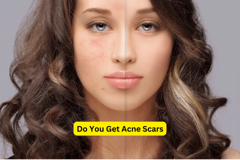 Discover the Secret Behind the World’s #1 Acne Cure: How Thousands Achieved Flawless Skin in 131 Countries!