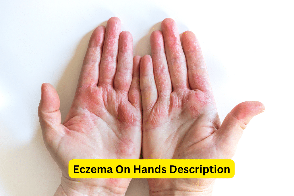 Eczema On Hands Description 