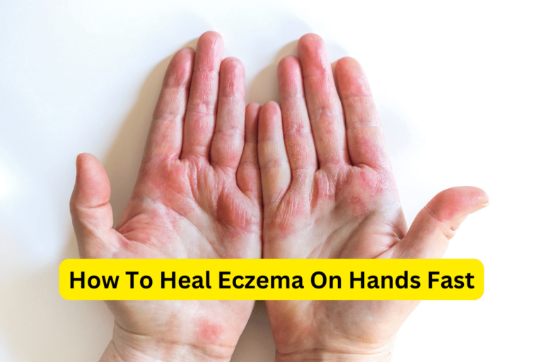 Heal Eczema on Hands in 3 Easy Steps: Fast Relief Strategies