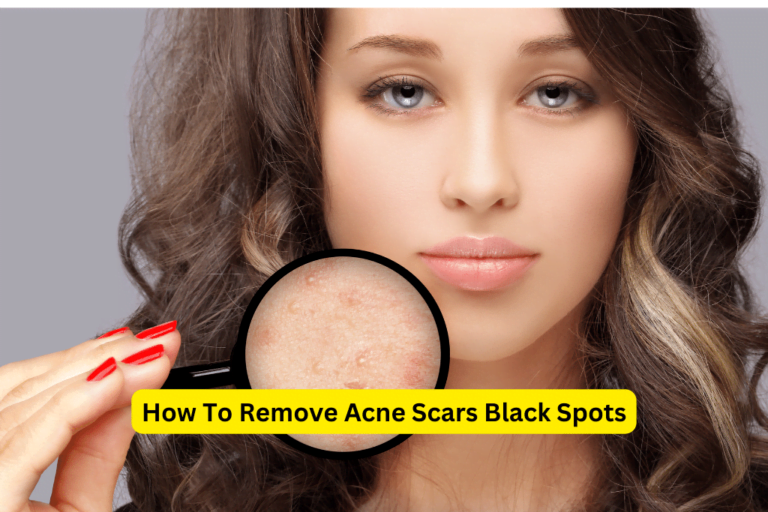 Banish Acne Scars: Remove Black Spots 