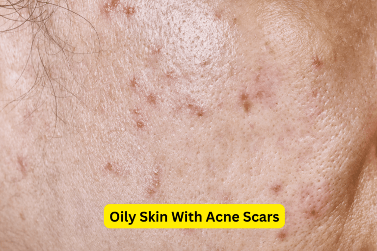 Effective Methods for Oily Skin & Acne Scar Treatment 