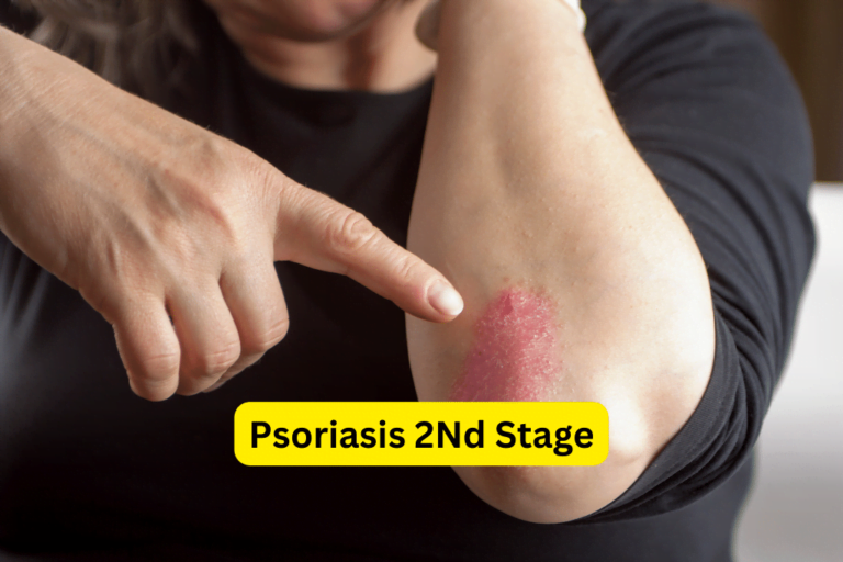 Boost Your Skin Healing Journey with Stage 2 Psoriasis Treatments