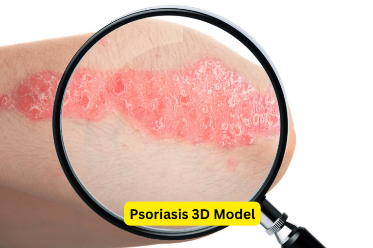 Discover the Beauty of Psoriasis with a Stunning 3D Model