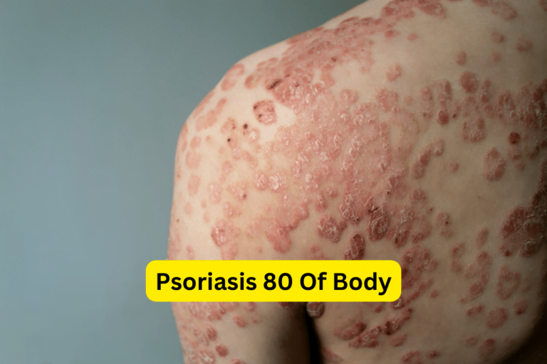 Discover Effective Treatments for Psoriasis Affecting 80% of Your Body 