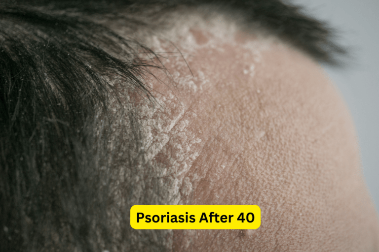 Managing Psoriasis After 40: Expert Tips for Clearer, Healthier Skin 