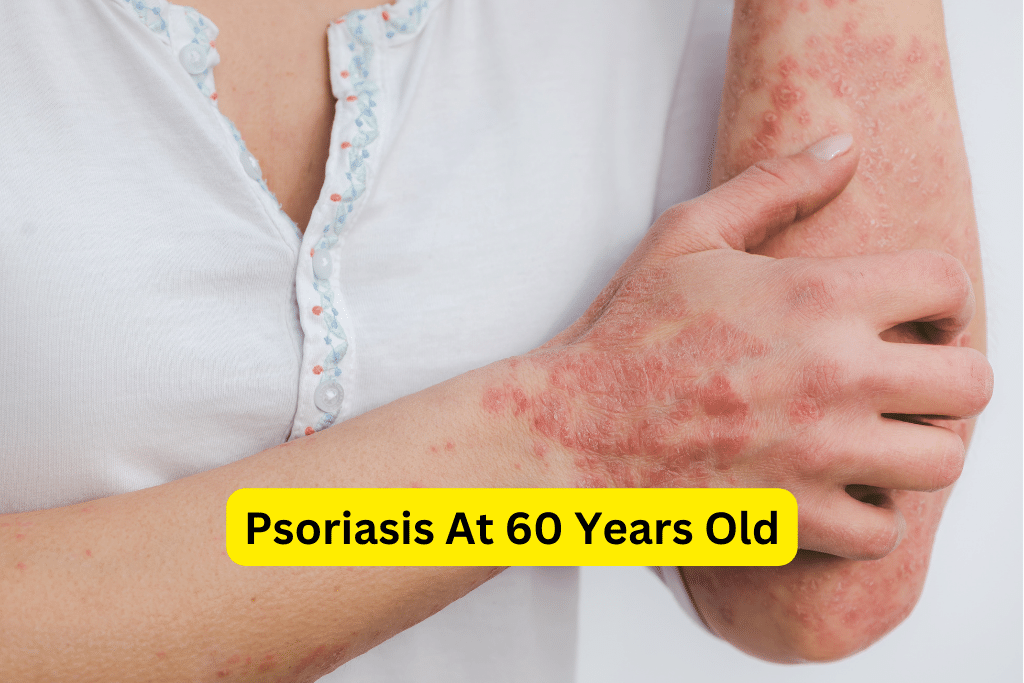 Managing Psoriasis at 60: Effective Strategies for Healthy Aging ...