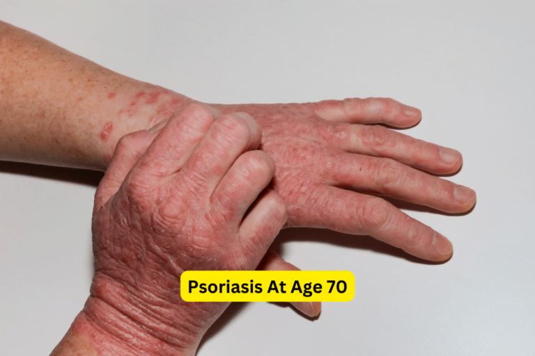 Empowering Psoriasis at 70: Knowledge and Effective Treatment Options