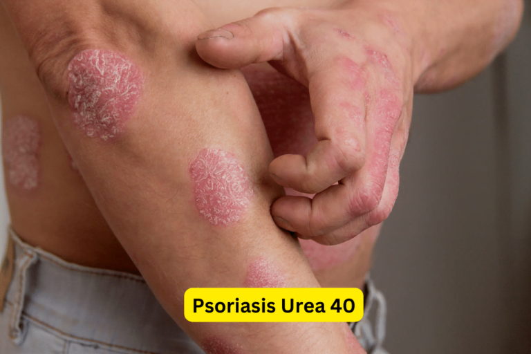 Heal and Soothe Your Skin with Psoriasis Urea 40 Cream 