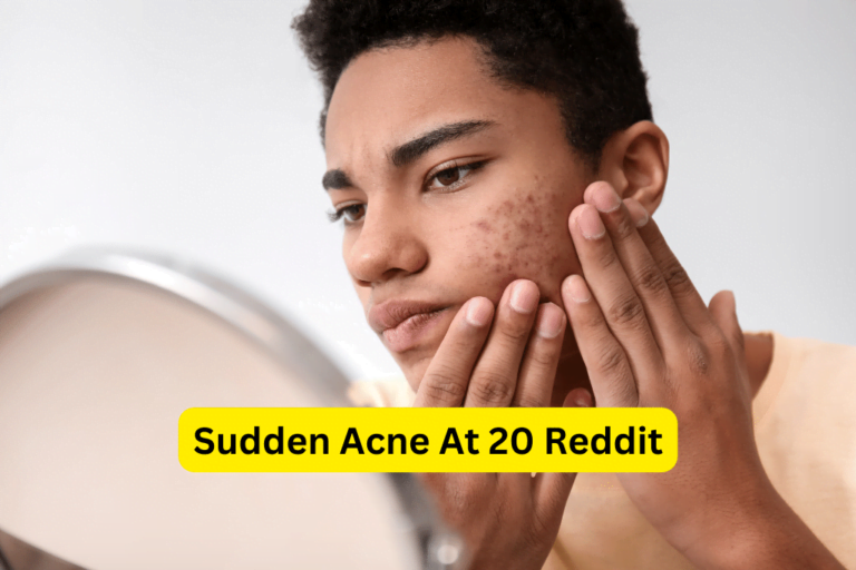 Dealing with Sudden Acne at 20: Insights from Reddit’s Community