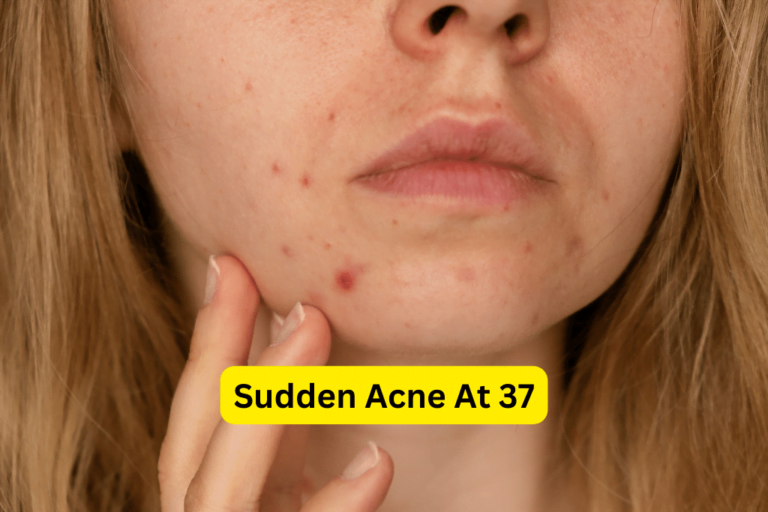 Sudden Acne at 37: Causes, Treatments, and Prevention 