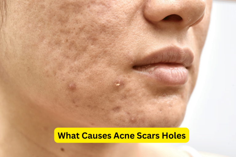 Understanding the Root Causes of Acne Scar Holes 