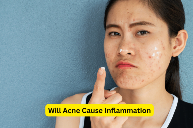 Uncover the Truth: How Acne Leads to Inflammation & Ways to Combat It 